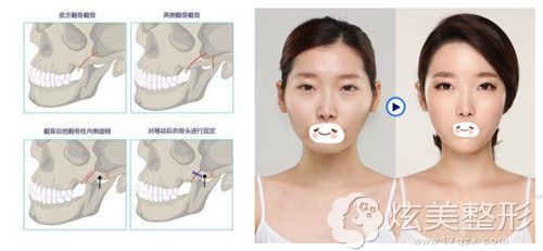 眼界大开
:韩国轮廓整形医生为您解答颧弓外扩和颧骨高有什么区别